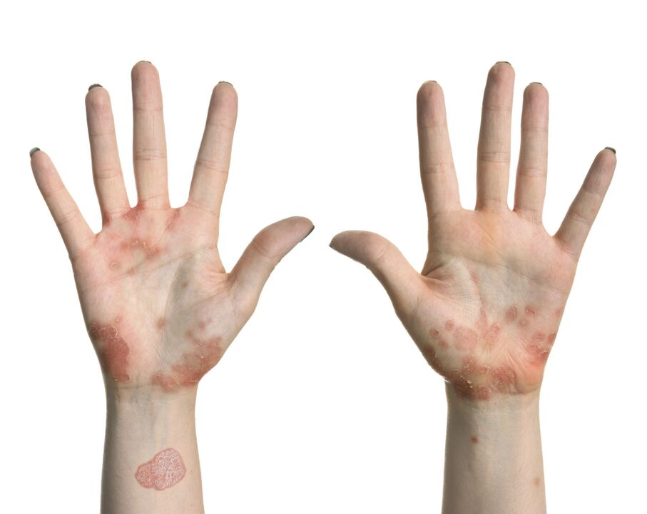 Early symptoms of psoriasis