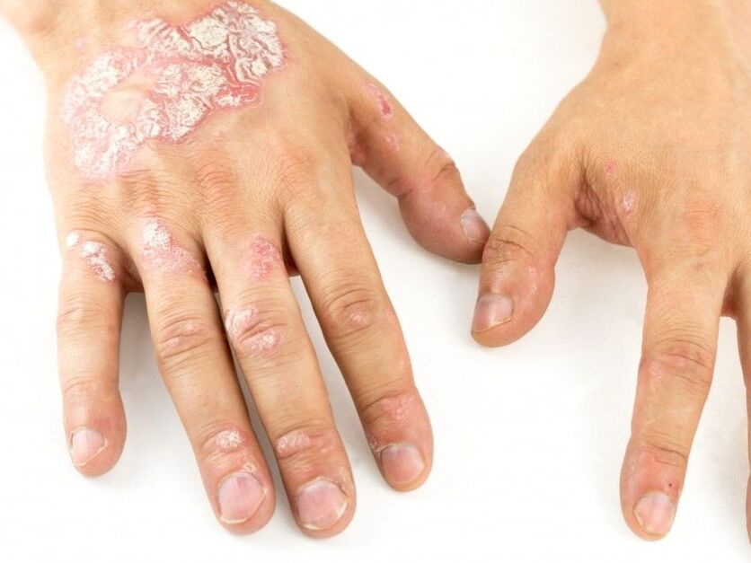 psoriasis on hands