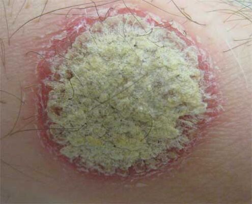 psoriasis